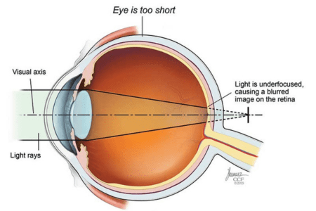 High Myopia or Hyperopia